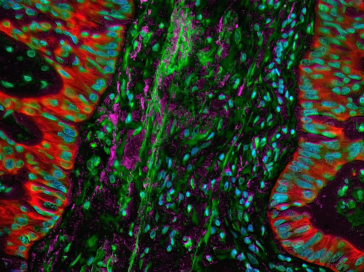 Microscope image of tumour tissue with dense supporting stroma.