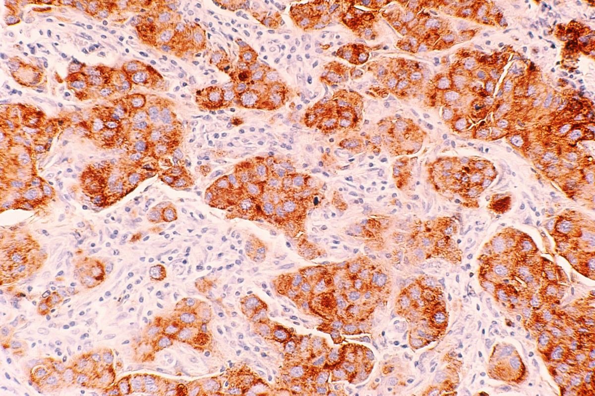 Microscope image of ductal carcinoma, a common form of breast cancer.
