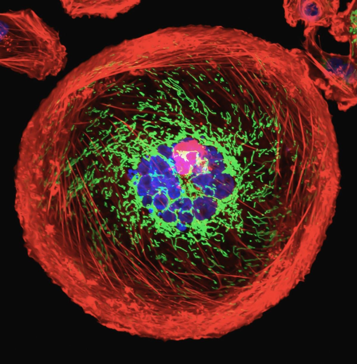 Microscope image of a single giant cancer cell in red and blue.