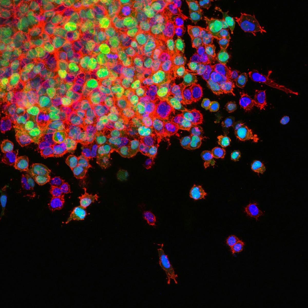 Fluorescent microscope image of spreading cancer cells.