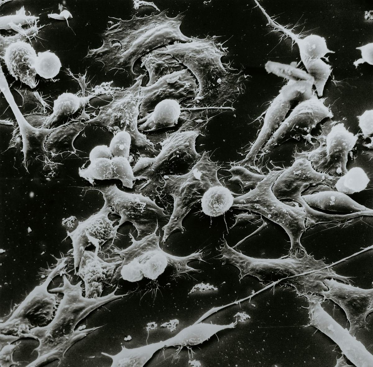 Microscope image of Wilms tumour, a kidney cancer.