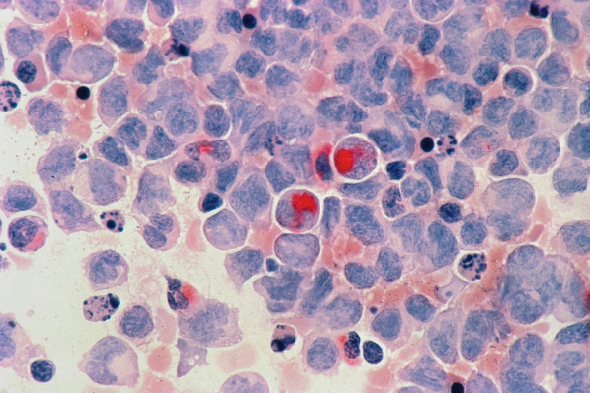 Microscope image of acute myeloid leukaemia cells.
