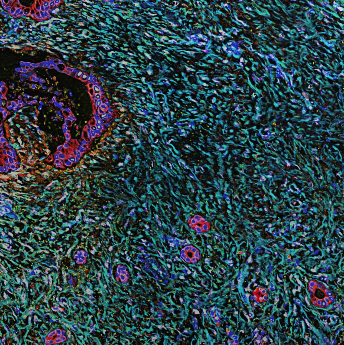 Microscope image of dense tumour tissue in purple and blue.