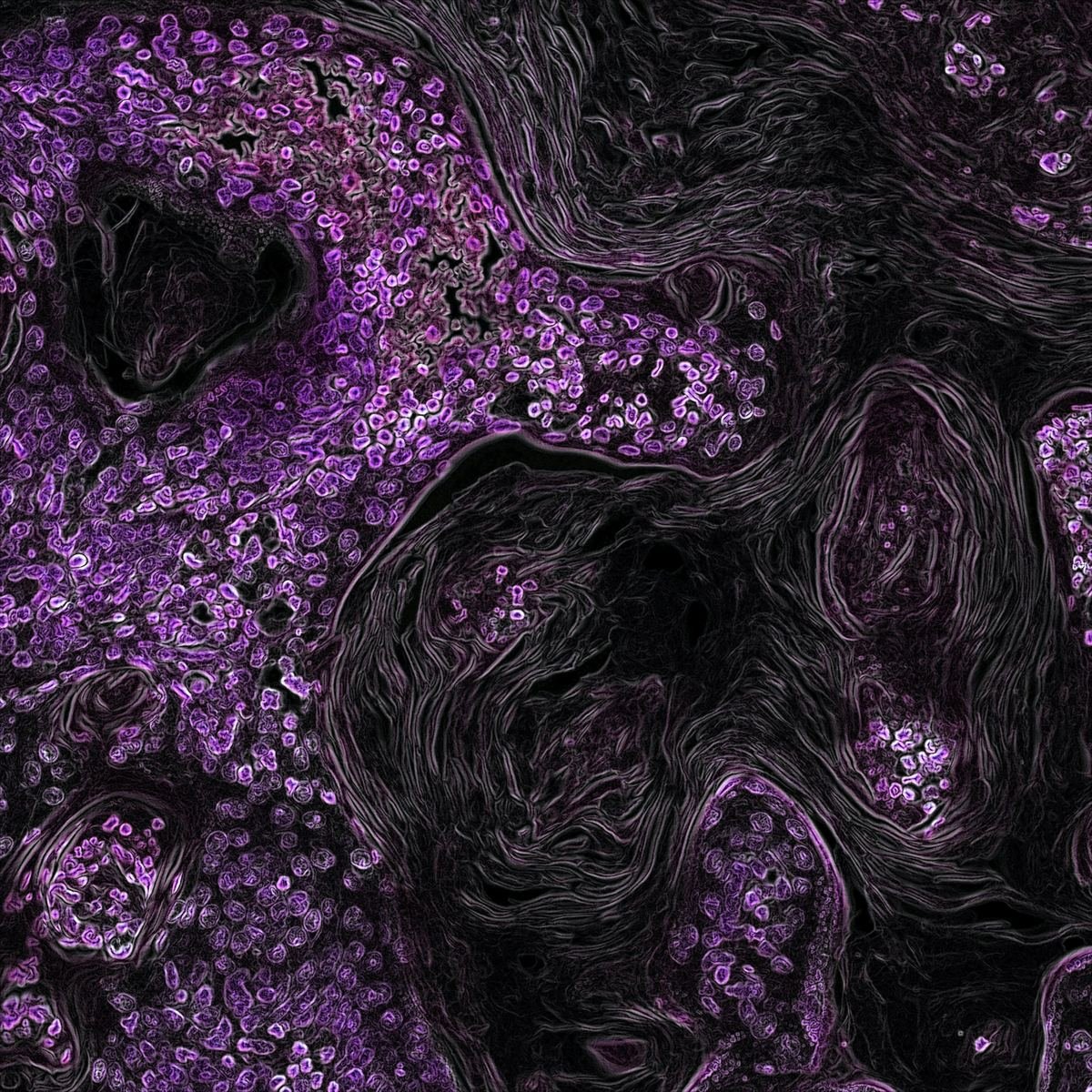 Microscope image of lung cancer tissue in purple and black.