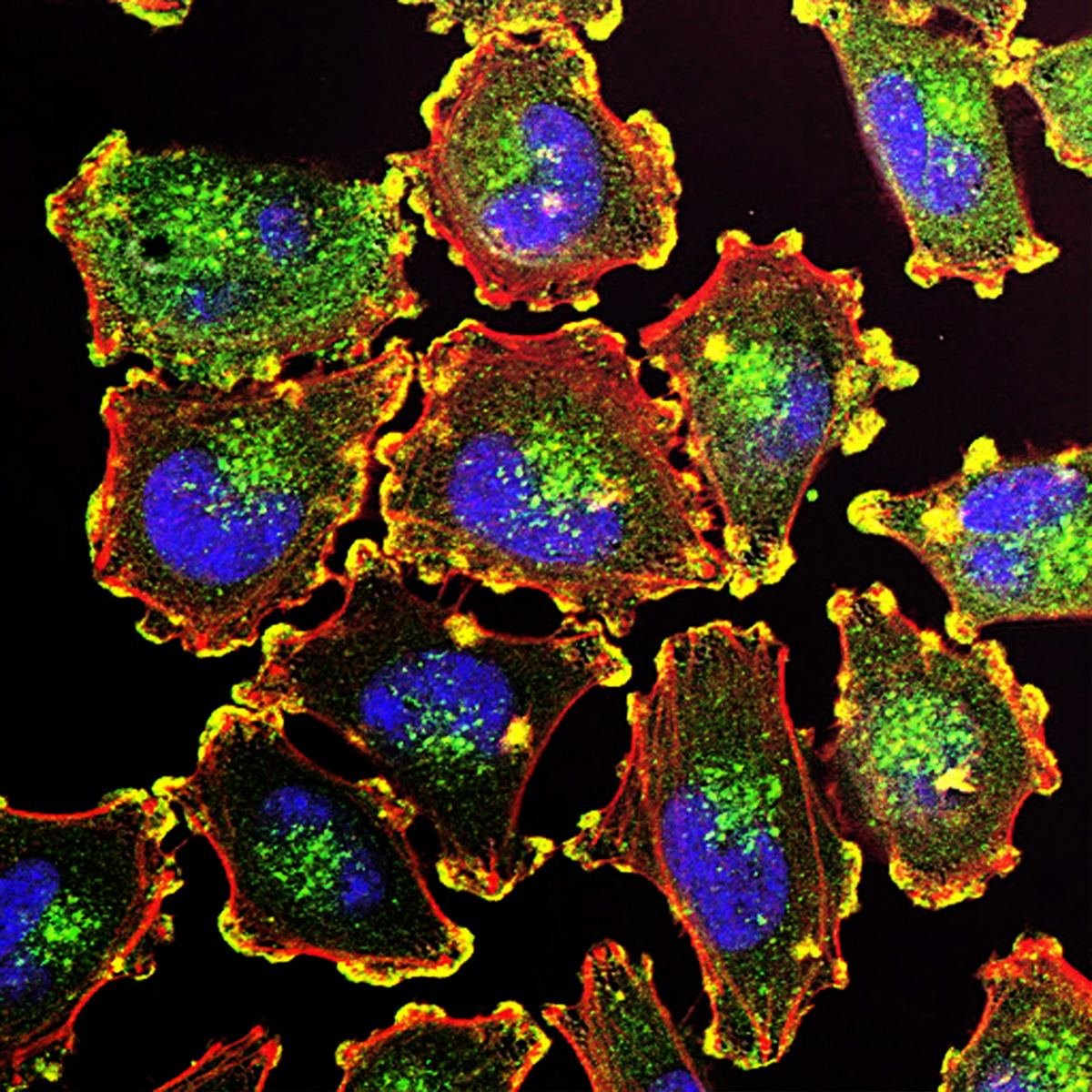 Fluorescent microscope image of metastatic melanoma cells.