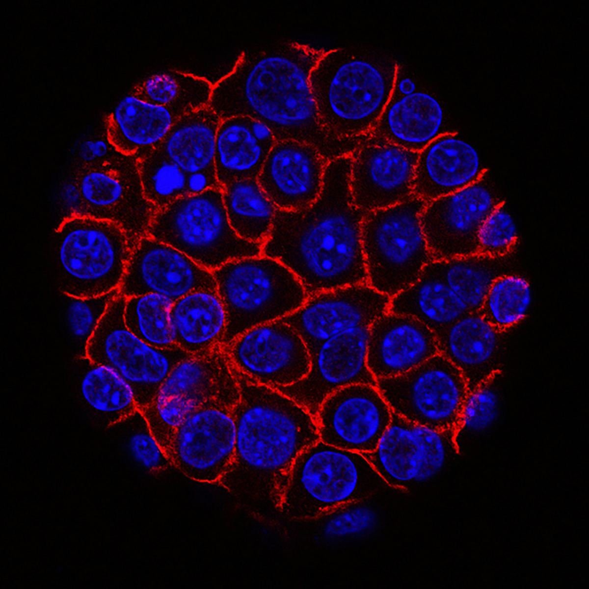 Fluorescent microscope image of pancreatic cancer cells.
